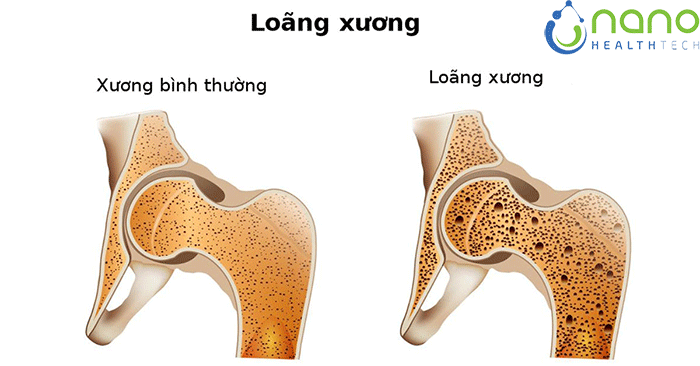 phan-loai-benh-loang-xuong